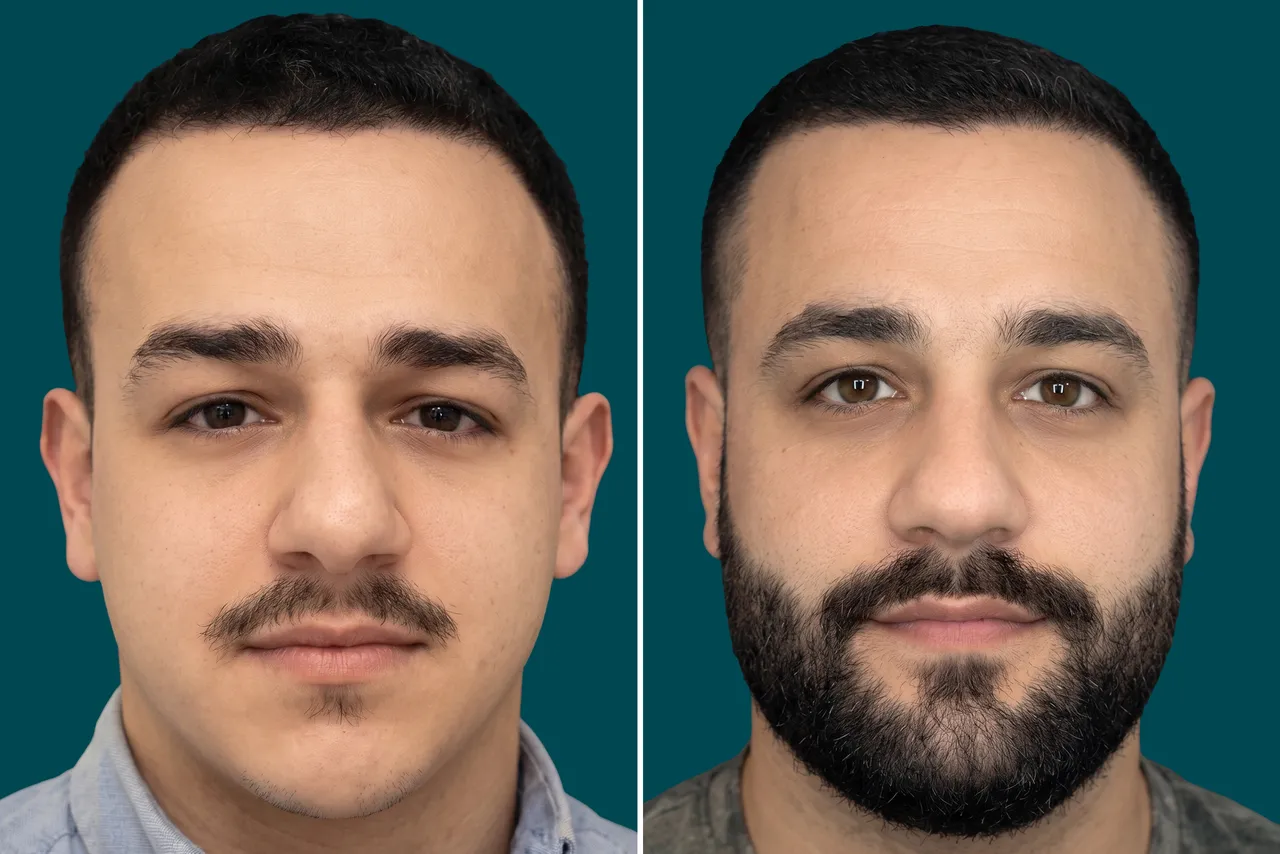 Beard Transplant 1